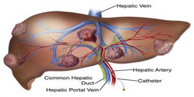 Karaciğerde Hemanjiom